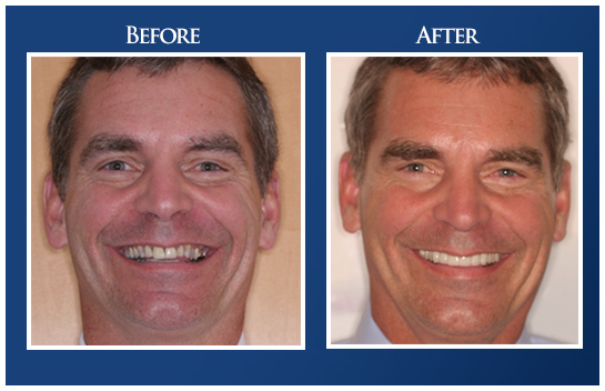 Advanced Care Dentistry Smile Gallery