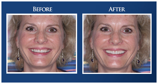 Advanced Care Dentistry Smile Gallery